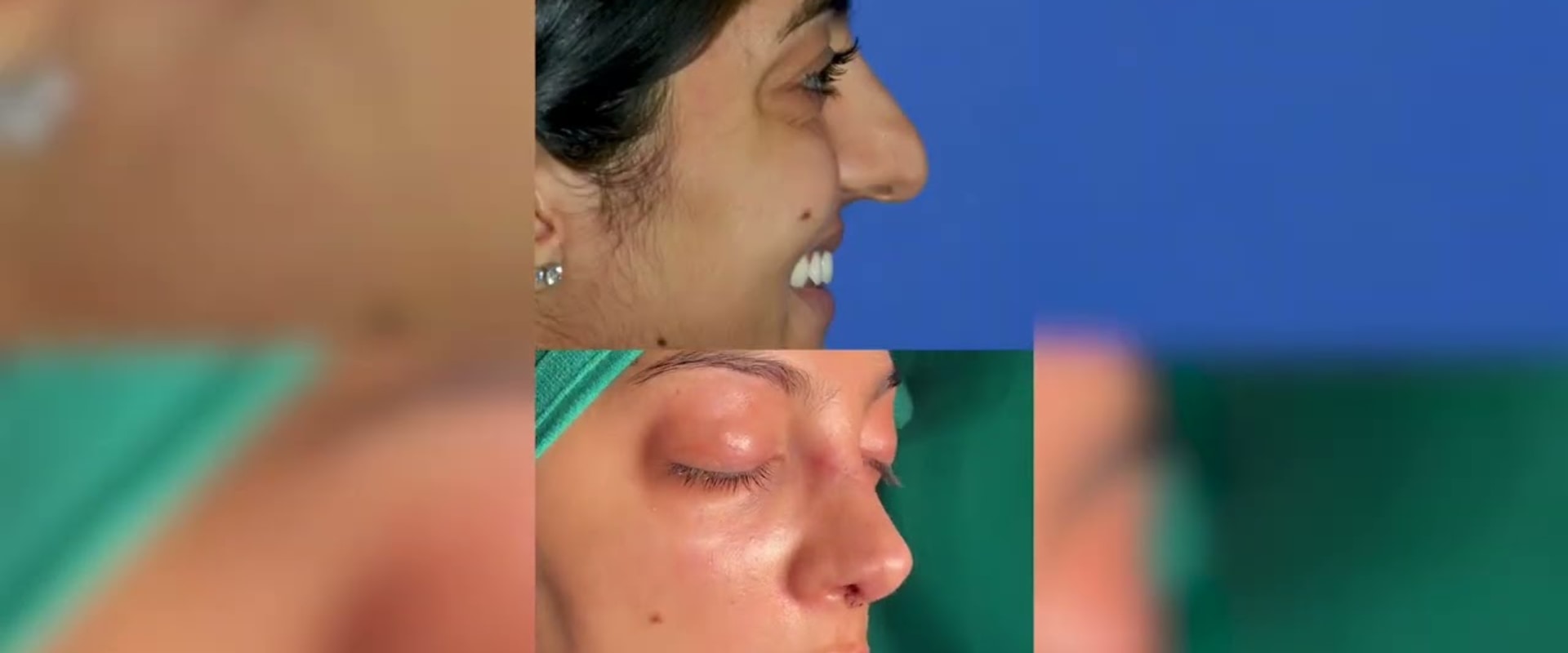 The Top Tier Rhinoplasty Surgeon in Beverly Hills