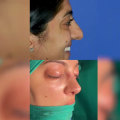 The Top Tier Rhinoplasty Surgeon in Beverly Hills