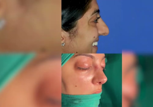 The Top Tier Rhinoplasty Surgeon in Beverly Hills